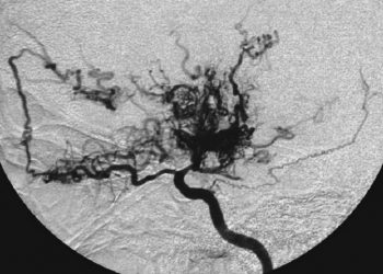 Kenali Penyakit Moyamoya Serta Gejalanya