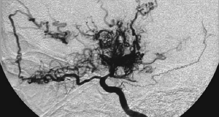 Kenali Penyakit Moyamoya Serta Gejalanya