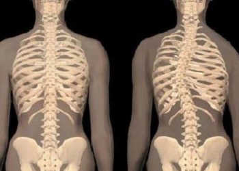 Beberapa Gejala dari Penyakit Skoliosis yang Perlu Kamu Ketahui