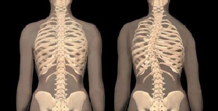 Beberapa Gejala dari Penyakit Skoliosis yang Perlu Kamu Ketahui