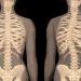 Beberapa Gejala dari Penyakit Skoliosis yang Perlu Kamu Ketahui