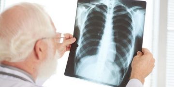 Benjolan di Leher Bisa Jadi Tanda Penyakit Tuberkulosis