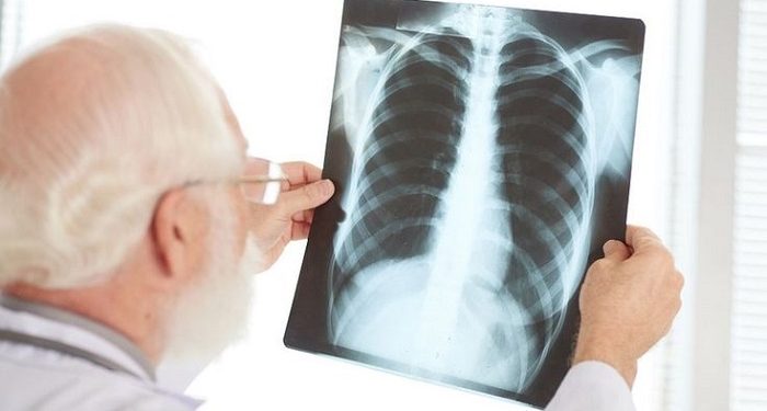 Benjolan di Leher Bisa Jadi Tanda Penyakit Tuberkulosis