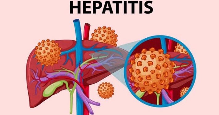 Kasus Hepatitis A di Eropa Alami Peningkatan Tajam