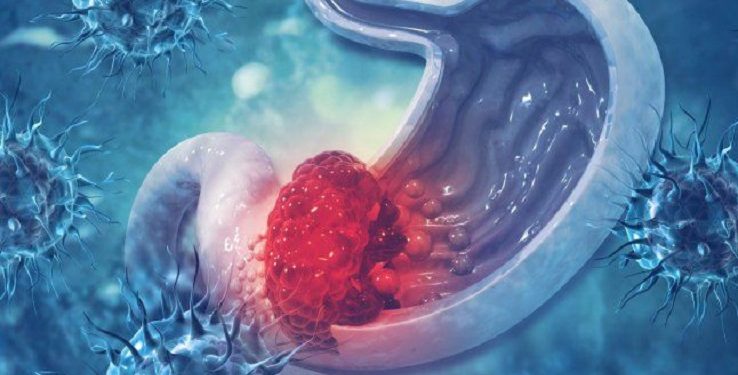 Gejala Awal pada Penderita Kanker Lambung