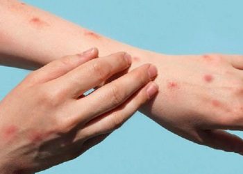 WHO Tetapkan Status Darurat Kesehatan Global untuk Mpox