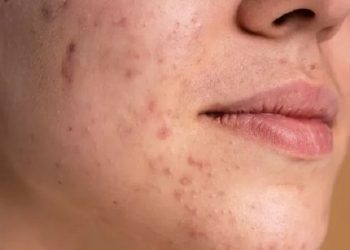 Tiga Faktor Utama yang Menyebabkan Skin Barrier Rusak