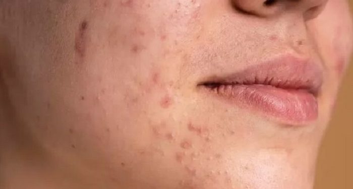 Tiga Faktor Utama yang Menyebabkan Skin Barrier Rusak