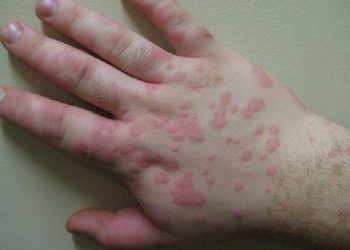 Kenali Stevens-Johnson Syndrome Penyakit Kulit yang Berbahaya