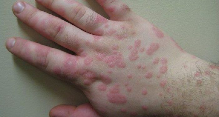 Kenali Stevens-Johnson Syndrome Penyakit Kulit yang Berbahaya