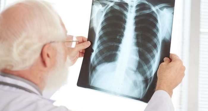 Sudinkes Jakarta Utara Catat 3 Ribu Kasus Tuberkulosis Sepanjang 2025