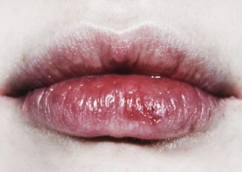 Tips Mengatasi Bibir Kering dan Pecah-Pecah