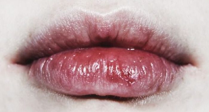 Tips Mengatasi Bibir Kering dan Pecah-Pecah