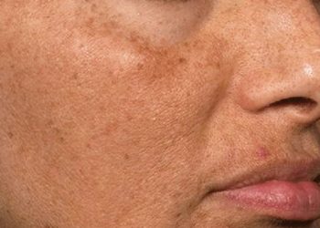 Simak Tiga Tanda Kulit Lelah yang Perlu Diperhatikan