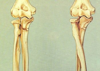 Kalsium dan Vitamin D Penting untuk Kekuatan Tulang