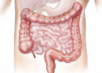 Kebiasaan Sehari-Hari yang bisa Merusak Kesehatan Usus