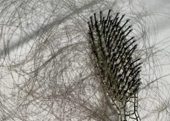 Kenali Apa Itu Androgenetik Alopesia pada Kerontokan Rambut