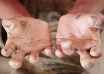 Tahun 2024, Kasus Kusta di Papua Barat Mencapai 796 Orang