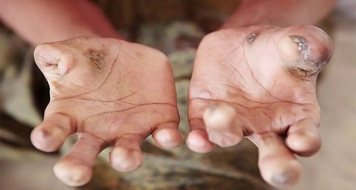 Tahun 2024, Kasus Kusta di Papua Barat Mencapai 796 Orang