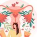 Waspada Peringatan Dini PCOS yang Bisa Muncul Sebelum Menstruasi Pertama