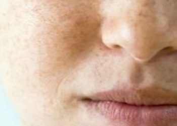 Simak Beberapa Produk yang Bisa Memperparah Flek Hitam di Wajah