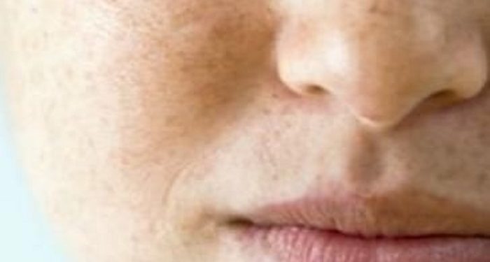 Simak Beberapa Produk yang Bisa Memperparah Flek Hitam di Wajah