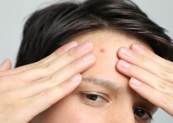 Jerawat Tidak Dipencet bisa jadi Flek Hitam di Wajah