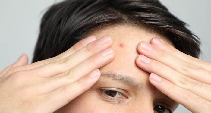 Jerawat Tidak Dipencet bisa jadi Flek Hitam di Wajah