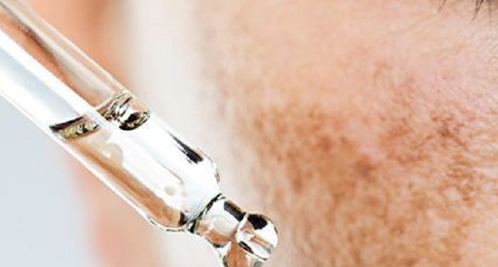 Teknik Khusus Makeup untuk Samarkan Melasma di Wajah