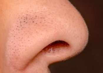 Tips Menghilangkan Bintik-Bintik Hitam di Wajah