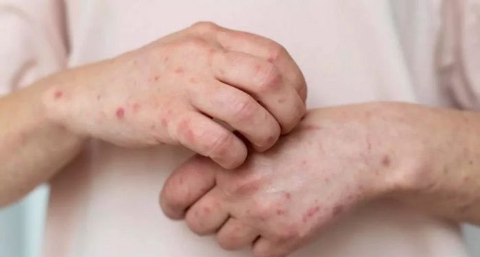 Kenali Beberapa Tanda Autoimun