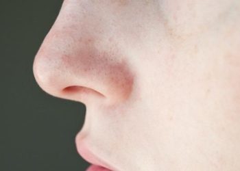 Cara Praktis Menghilangkan Komedo di Wajah