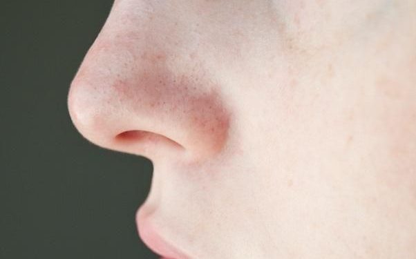 Cara Praktis Menghilangkan Komedo di Wajah