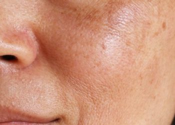 Mengatasi Hiperpigmentasi Bukan Proses yang Instan