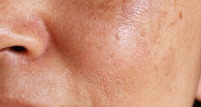 Mengatasi Hiperpigmentasi Bukan Proses yang Instan