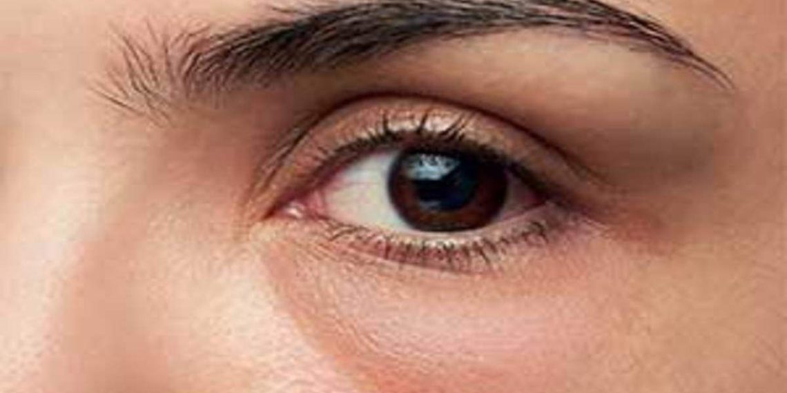 Tips Ampuh Mengatasi Kantung Mata dan Lingkaran Hitam