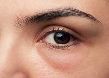 Tips Ampuh Mengatasi Kantung Mata dan Lingkaran Hitam