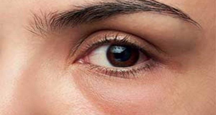 Tips Ampuh Mengatasi Kantung Mata dan Lingkaran Hitam