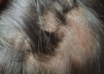 Tidur dengan Rambut Basah bisa Terinfeksi Jamur di Kulit Kepala