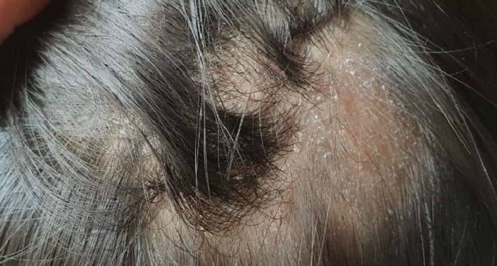 Tidur dengan Rambut Basah bisa Terinfeksi Jamur di Kulit Kepala