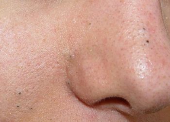 Cara Atasi Komedo Hitam agar Pori-Pori Bersih