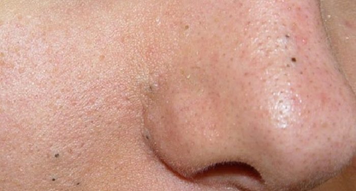 Cara Atasi Komedo Hitam agar Pori-Pori Bersih