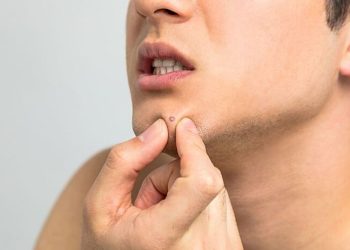 Cara Menangani dan Merawat Kulit Sensitif dari Jerawat