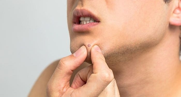 Cara Menangani dan Merawat Kulit Sensitif dari Jerawat