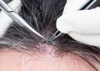 Bahaya Mencabut Uban bisa Merusak Folikel Rambut