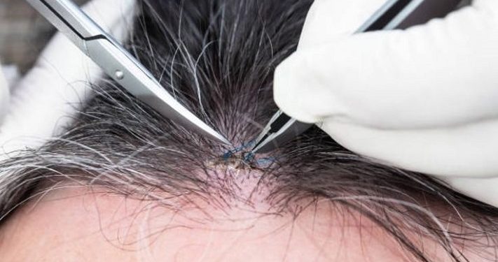 Bahaya Mencabut Uban bisa Merusak Folikel Rambut