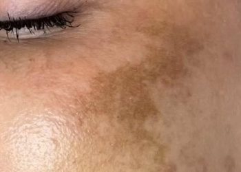 Tidak Semua Flek Hitam bisa Berkaitan dengan Usia