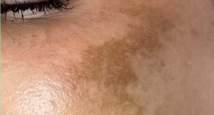 Tidak Semua Flek Hitam bisa Berkaitan dengan Usia