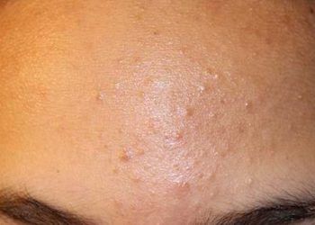 Ketahui Penyebab Jerawat di Dahi yang Bergerombol