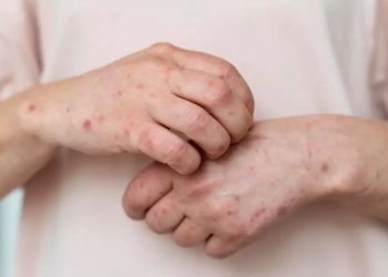 Kenali Gejala Awal dari Penyakit Campak